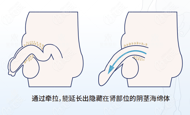 怎樣延長陰莖長度