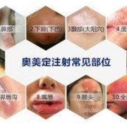 沈陽取奧美定手術(shù)要多少錢