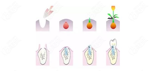 牙槽骨的高度在5-8mm可以种牙吗