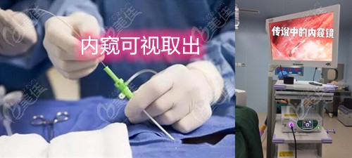 南宁做隆鼻、隆胸奥美定取出大概多少钱