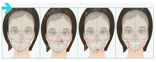 偏颌做正颌手术矫正是做单颌好还是双颌好