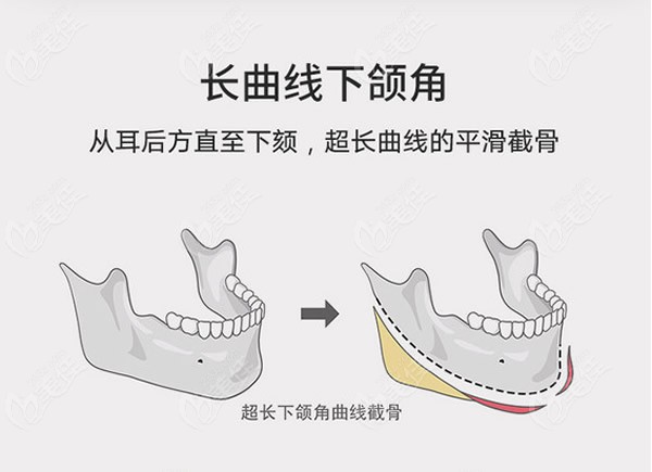 盘点上海排名前十的下颌角磨骨医生和医院