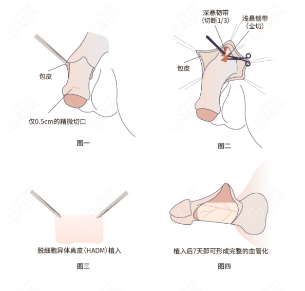 丁丁延长术图片