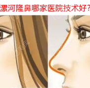 漯河隆鼻哪家醫(yī)院技術(shù)好