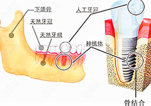 種植德國(guó)進(jìn)口牙多少錢一顆