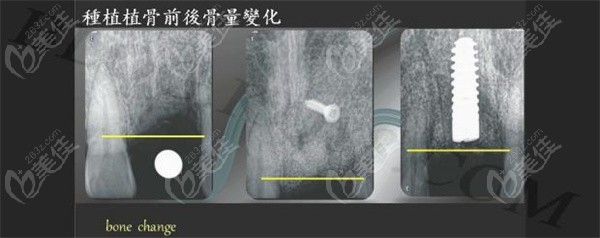 onlay植骨和inlay的区别