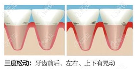 老人牙齒松動可以固定嗎