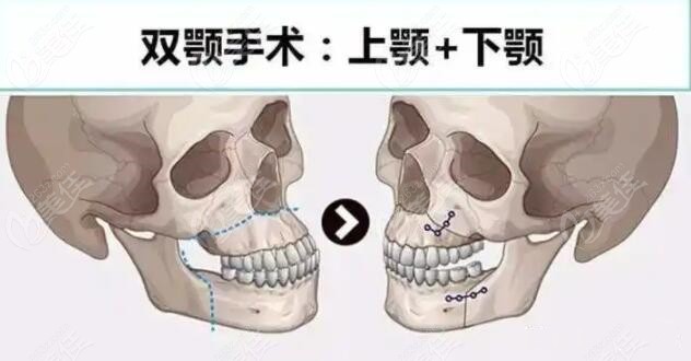 雙頜前突矯正前后對比照片記錄臉型變化