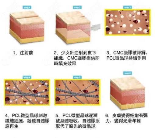 伊妍仕Ellanse少女针S、M、L、E四个型号的区别是啥