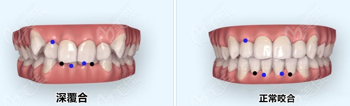 矫正收完牙缝还是深覆合怎么办