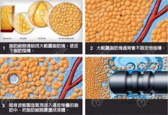 吸脂做水動(dòng)力好還是黃金微雕好