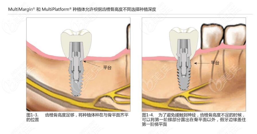 先了解美國AIDI種植系統(tǒng)的材質(zhì)和優(yōu)點(diǎn)