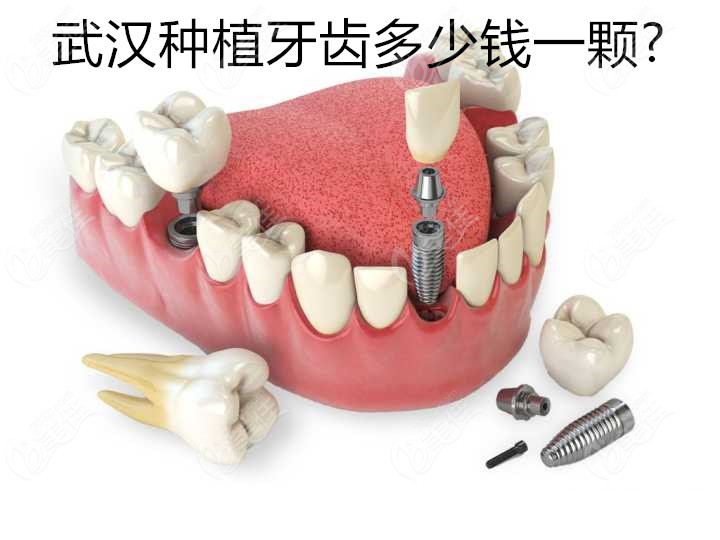 武汉种植牙齿多少钱一颗