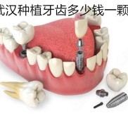 武漢種植牙齒多少錢一顆