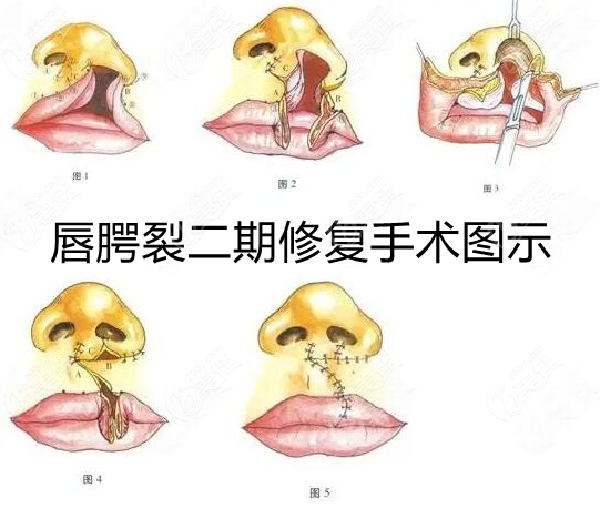 重庆北部宽仁医院唇腭裂修复手术收费不贵