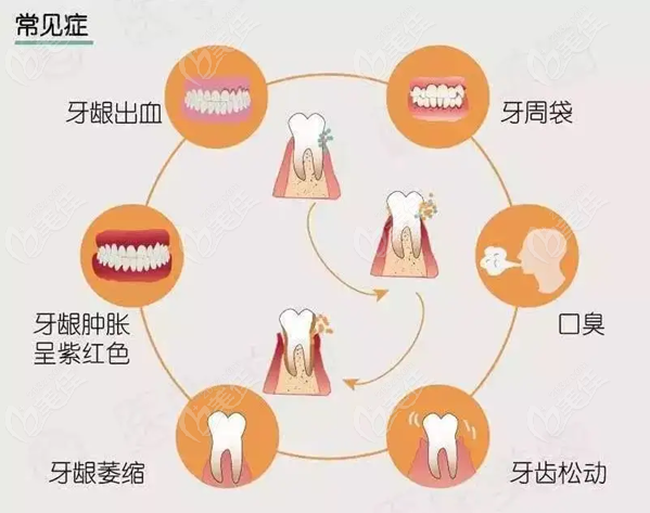 牙周炎一定要全口刮治嗎