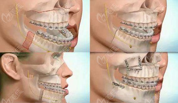 把正颌手术和削骨手术的区别说完就分析做正颌的时候能不能一起做削骨