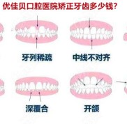 烏魯木齊優(yōu)佳貝口腔醫(yī)院矯正牙齒多少錢