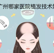 廣州哪家醫(yī)院植發(fā)技術(shù)好
