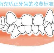 南充矯正牙齒收費標準已更新