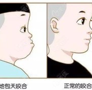 濟南地包天牙齒矯正哪家牙科比較好