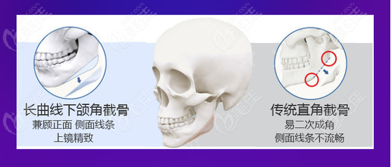 广州下颌角磨骨手术大概多少钱