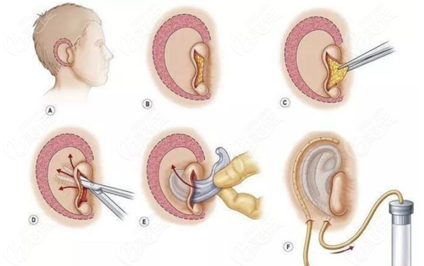 國內(nèi)先天性耳朵畸形再造手術(shù)多少錢