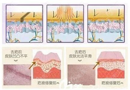 帕洛瑪激光和點陣激光哪個祛痘疤成效更好