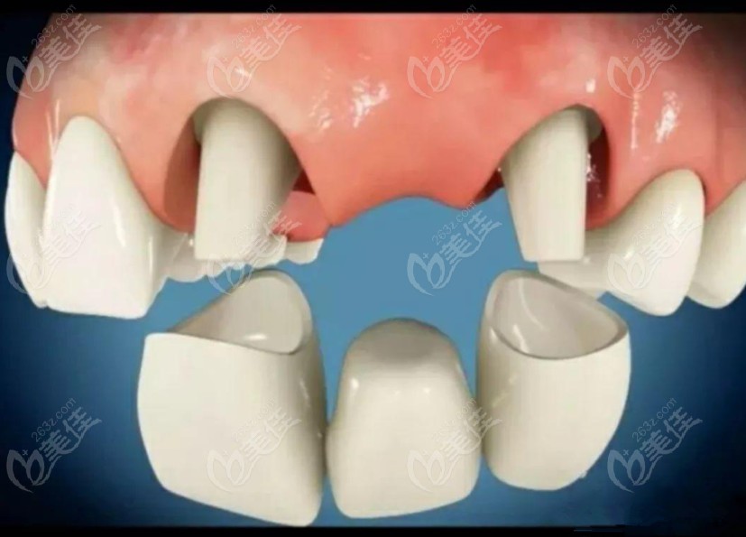 連續(xù)缺三顆牙較好的治療方法有鑲牙and種植牙