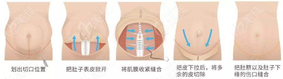 做完腹壁成型術(shù)后還可以生孩子嗎