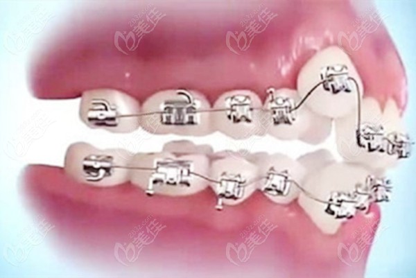 箍牙医生不建议我拔牙是因为他的技术不行吗