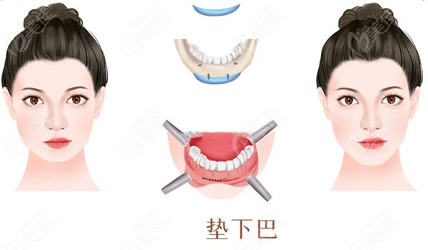 下巴后縮做假體墊下巴好還是截骨前移好呢