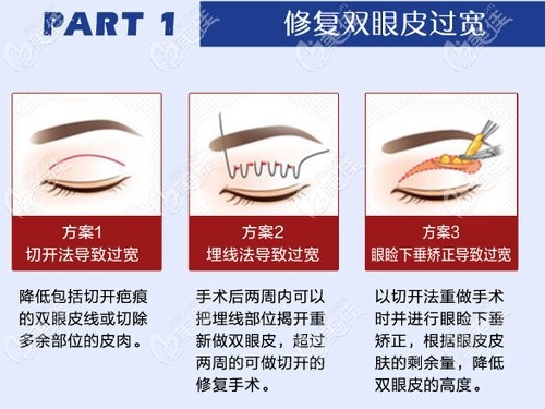 在武汉美基元做完双眼皮修复后发现医院的眼睛失败修复方法有很多