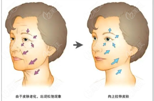 面部韧带提升可以取出吗