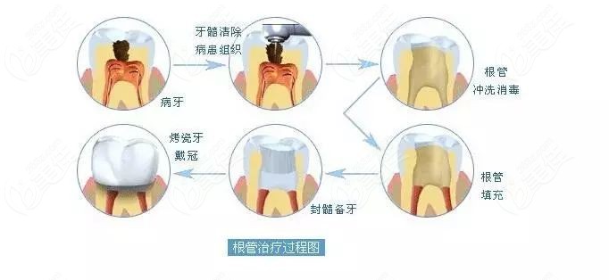 了解完杭州根管治疗一颗牙齿多少钱后