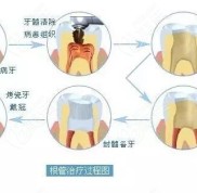 了解完杭州根管治療一顆牙齒多少錢后