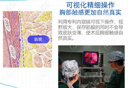 花5万多在杭州格莱美做的曼托假体隆胸真的超值