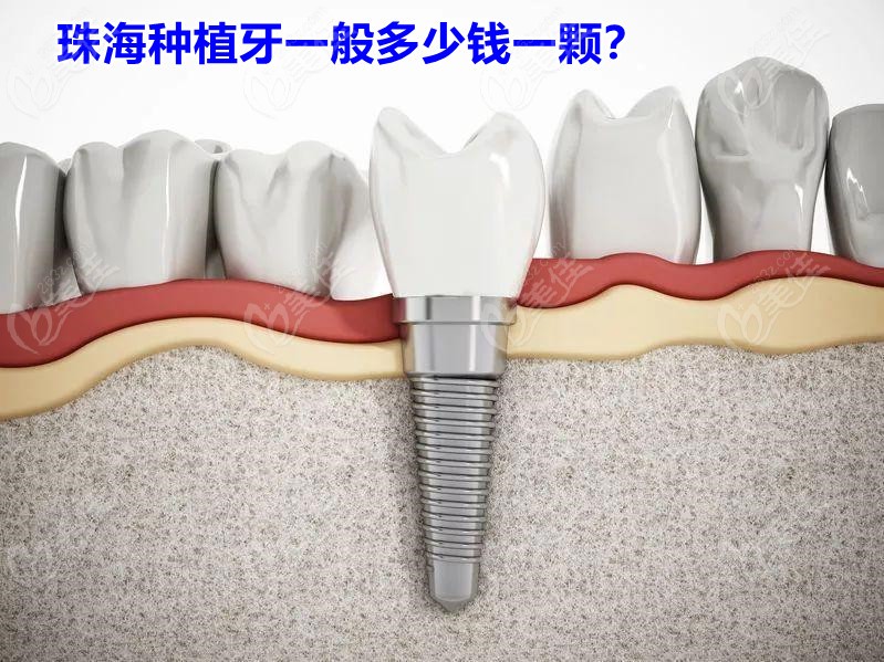 2022珠海地區(qū)種植牙多少錢一顆