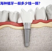 2024珠海地區(qū)種植牙多少錢一顆