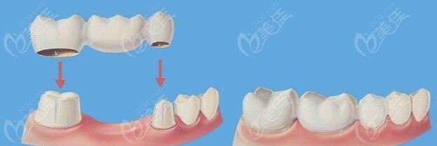 不想種植牙不用磨兩邊牙隱形鑲牙方法有嗎