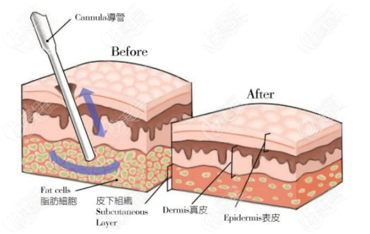 吸脂失敗修復(fù)醫(yī)生有哪些