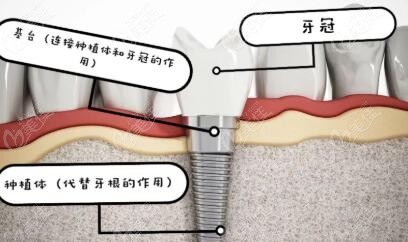 种植牙的连接方式有三种
