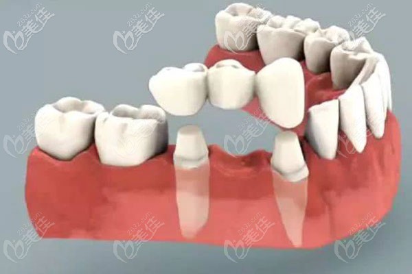 做全烤瓷牙带牙冠一定要磨左右两旁的牙齿吗