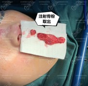 成都王宇琨做的鼻子怎么樣