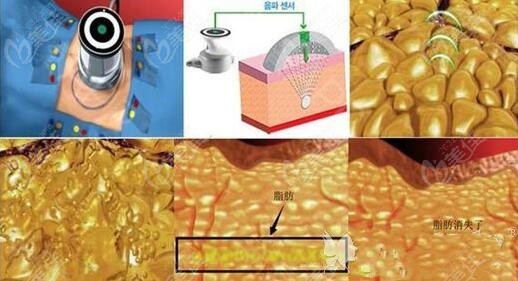 大腿抽脂手術(shù)對(duì)身體有什么副作用