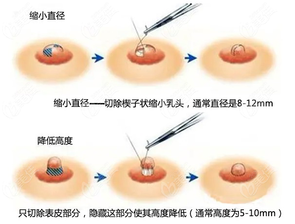 棒棒糖縮胸是什么