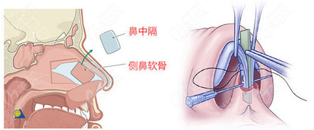 問贛州華美方賢成醫(yī)生做鼻子技術(shù)好不好