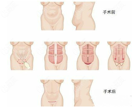 做完腹壁成型術(shù)后還可以生孩子嗎