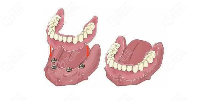 全口假牙的种类和价格解析
