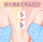 揚州哪家豐胸醫(yī)院好